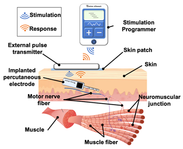 周邊神經肌肉再生電刺激植入治療應用系統的運作